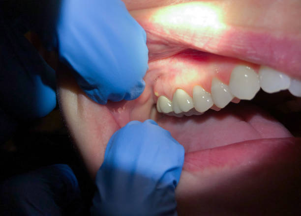 Best Emergency Wisdom Teeth Removal in Ozk, AR