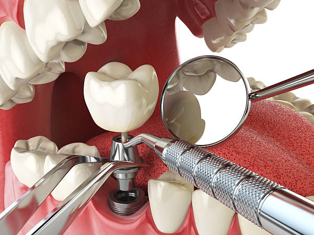 Best Emergency Root Canal Treatment in Ozk, AR